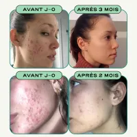 Test Circles CLEAR Cure 3 Mois : une aide correcte contre l’acné hormonale, mais pas magique